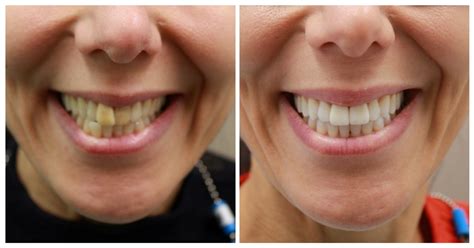 best teeth whitening with invisalign.